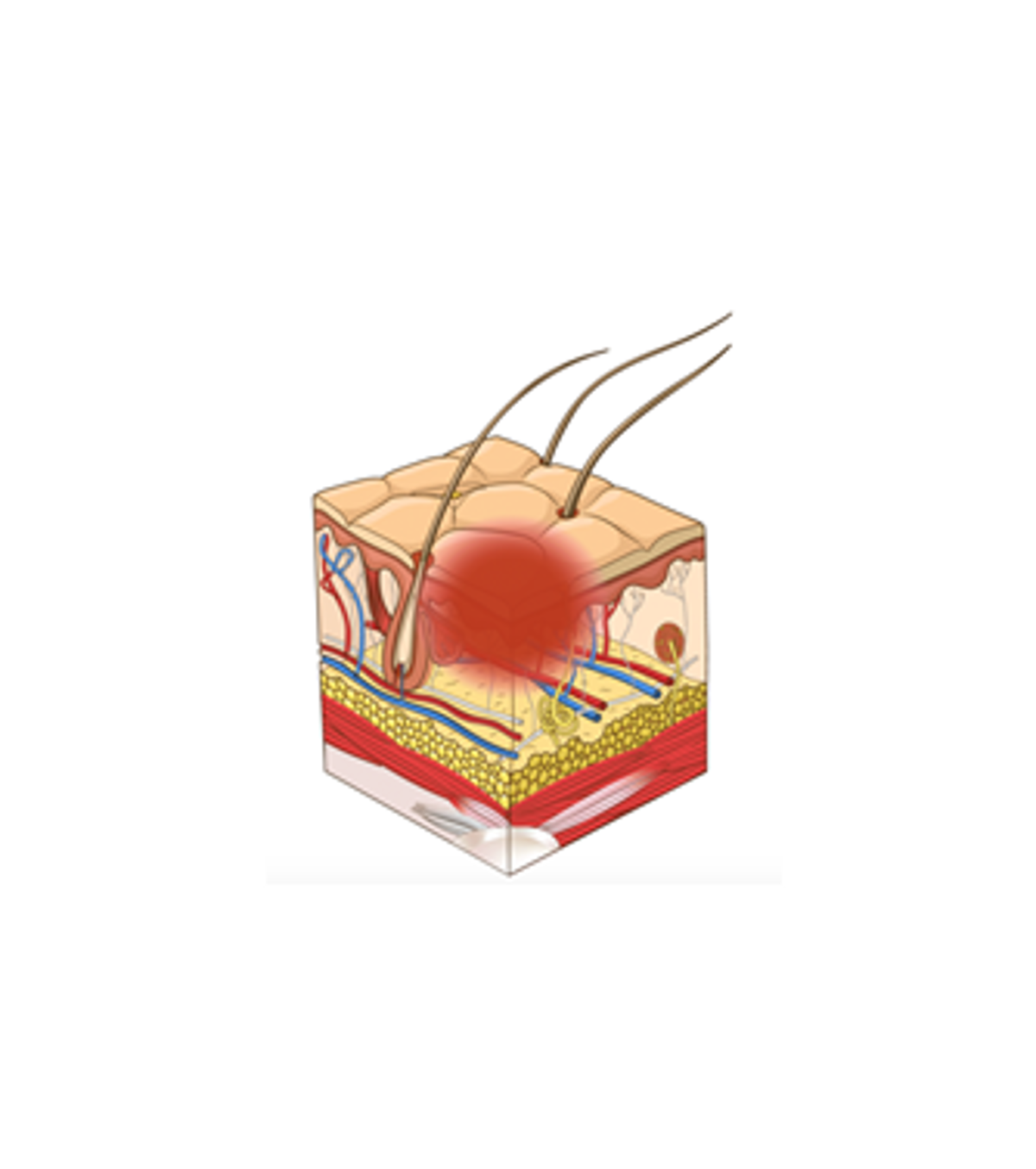 Stage 1: Non-blanchable erythema