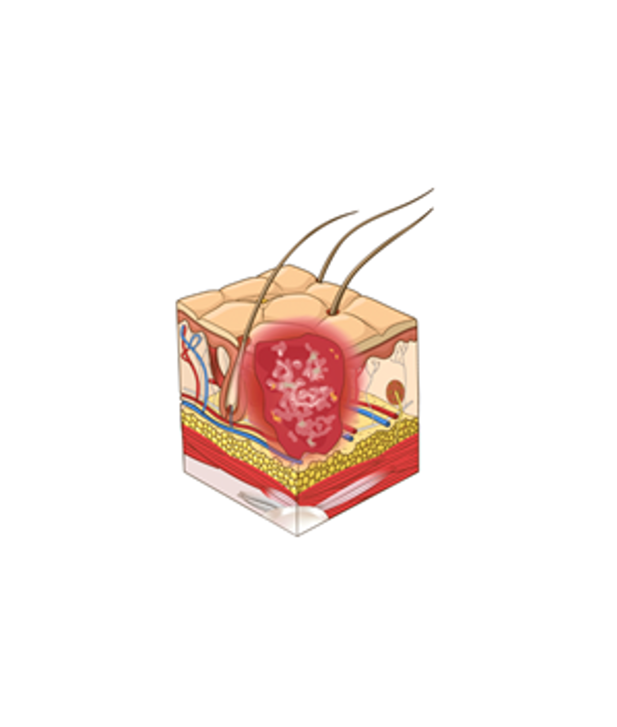 Stage 3: Full-thickness skin loss