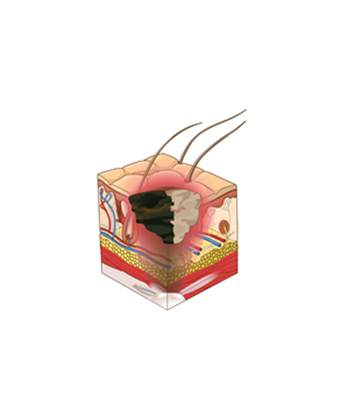 Unstageable: obscured full-thickness skin and tissue loss