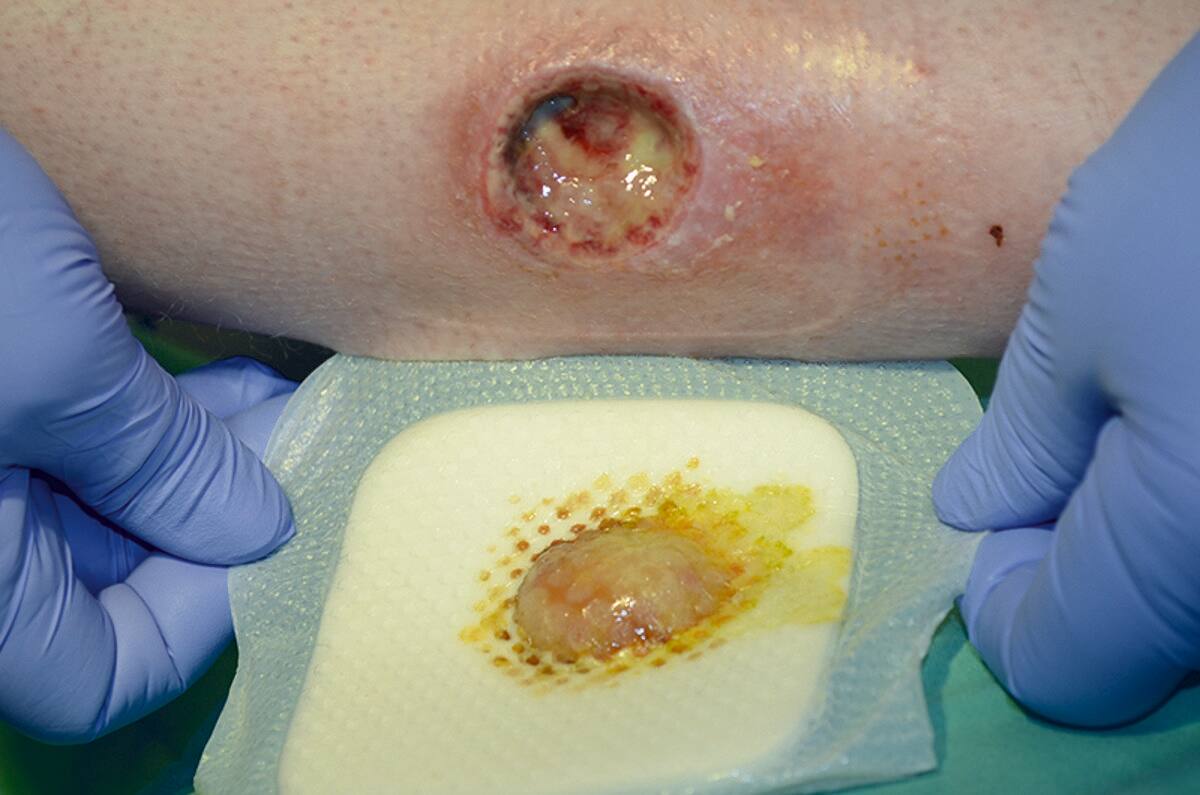 Pressure injury management