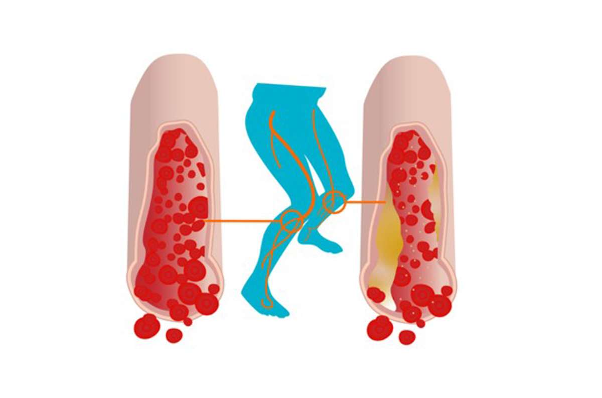 How Peripheral diabetic neuropathy affects blood flow