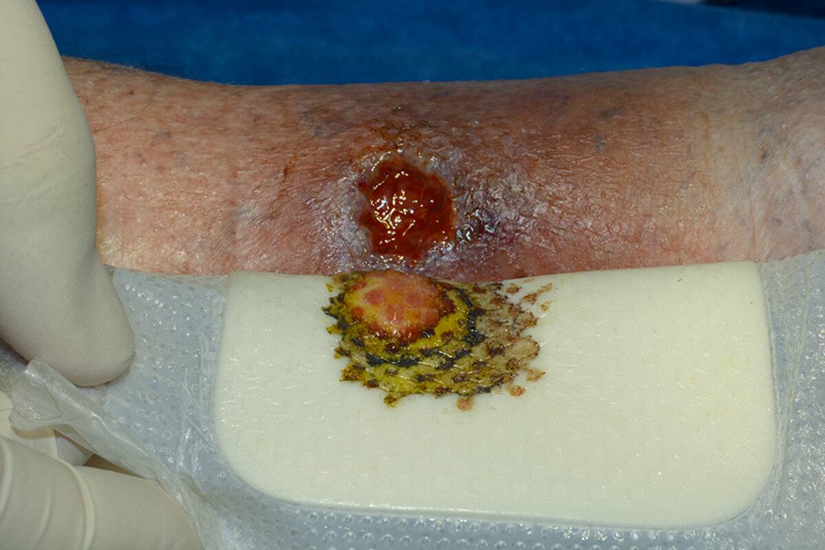 How to use silver dressings?