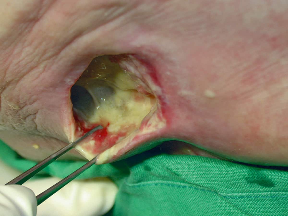 Sacral pressure ulcer with sloughy exudate. Example of a wound where a gelling fibre would be the recommended primaty dressing
