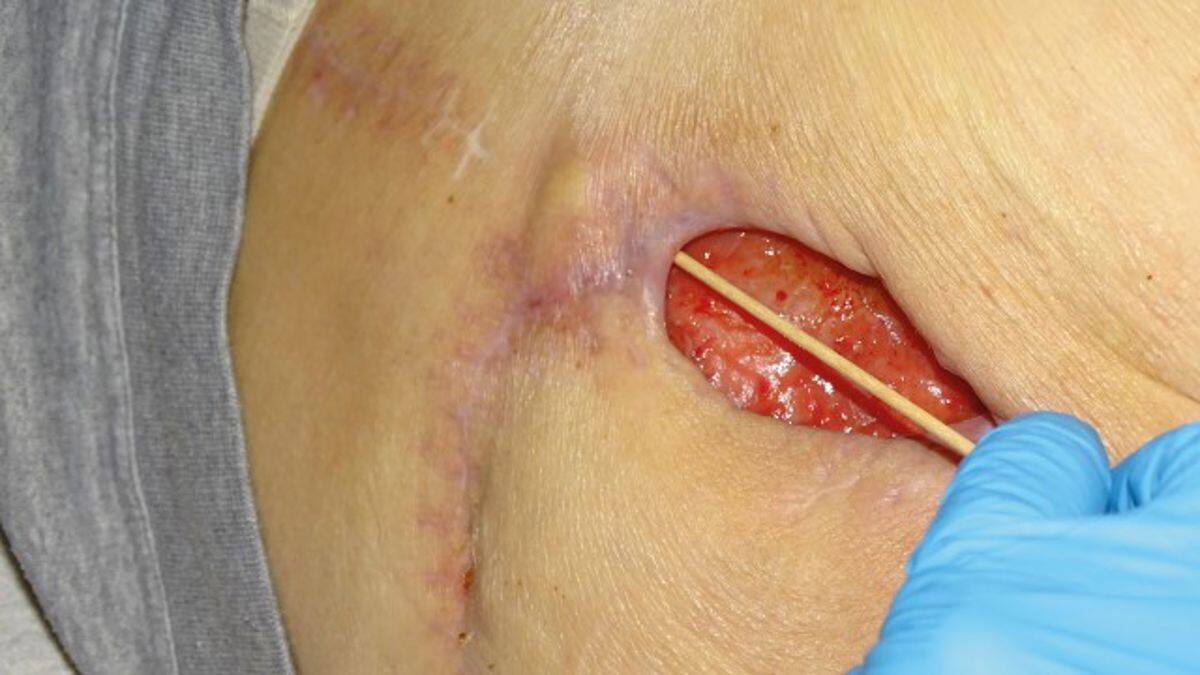 Sacral wound with undermining before the application of a gelling fibre dressing