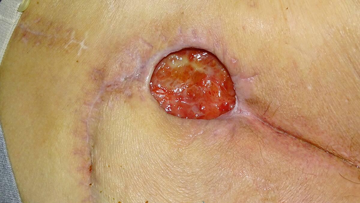 Dressing change after 2 days. Sacral wound after removal of gelling fibre dressing.
