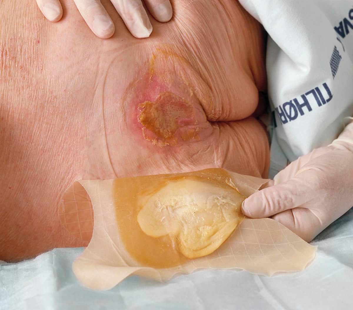 Here are some important factors to consider when selecting a hydrocolloid dressing: