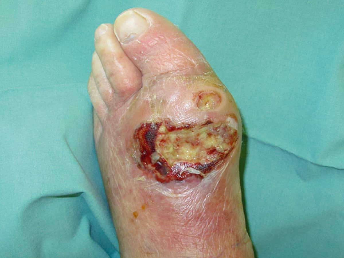 How do I know a diabetic foot ulcer is infected?