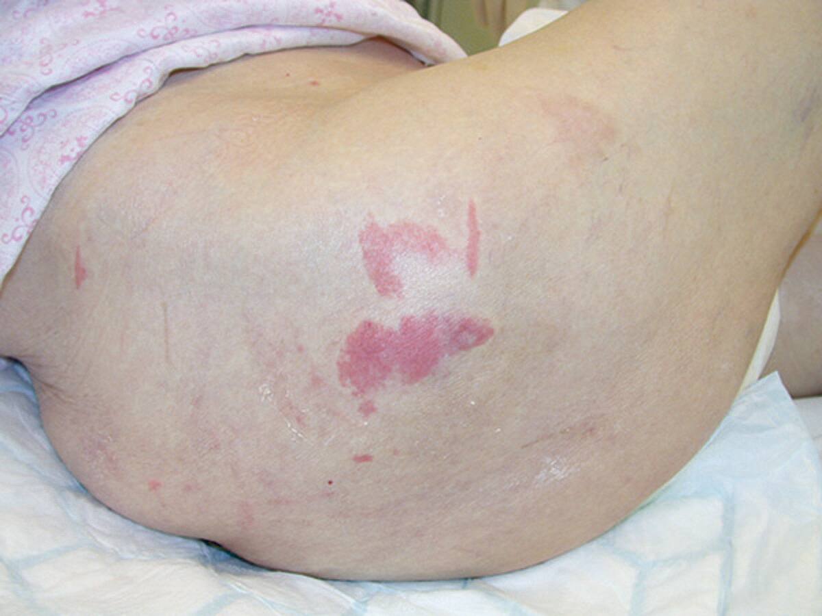 Pressure injury prevention