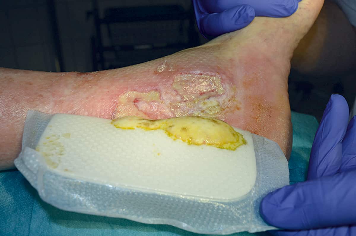 How to manage diabetic foot ulcers