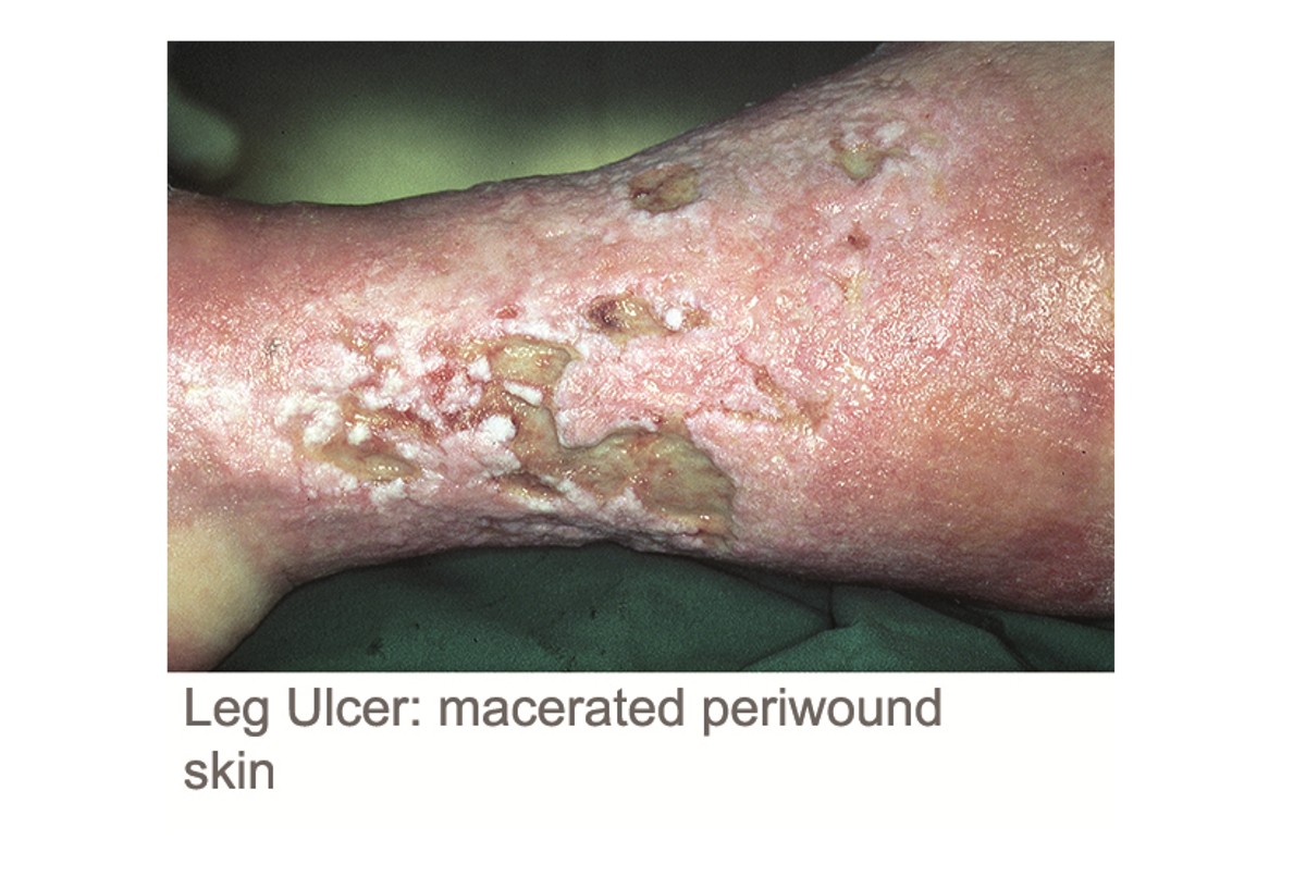 Assessing the periwound skin