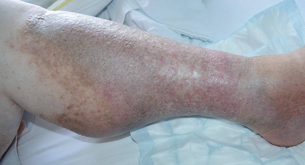 Lower limb ulcer