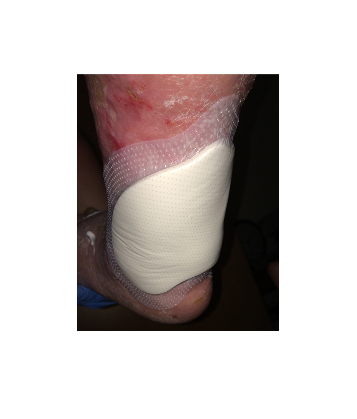 How to select the right wound dressing