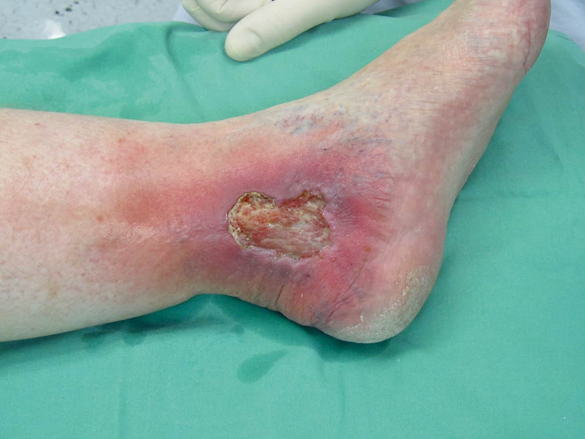 Leg ulcers: what are they and how do you treat them?