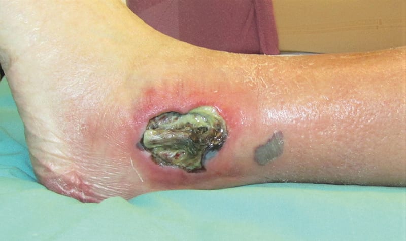 Arterial Leg Ulcer Photo