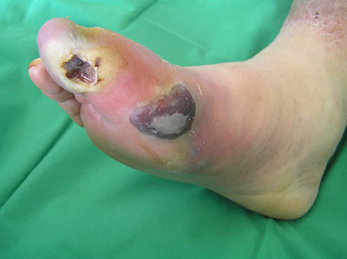 Diabetic foot ulcers: what are they and how do you manage them?