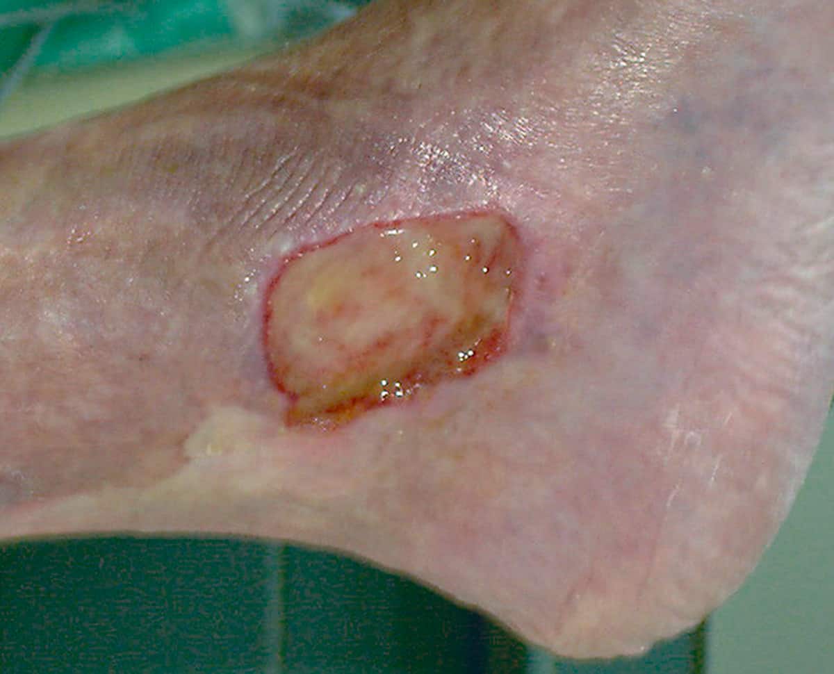 What is a venous leg ulcer and why does it occur? 