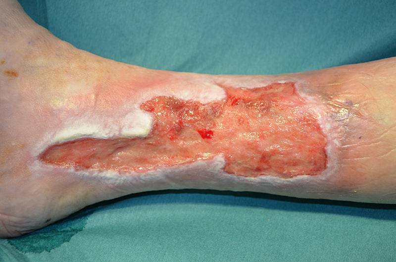 Venous Leg Ulcer Photo