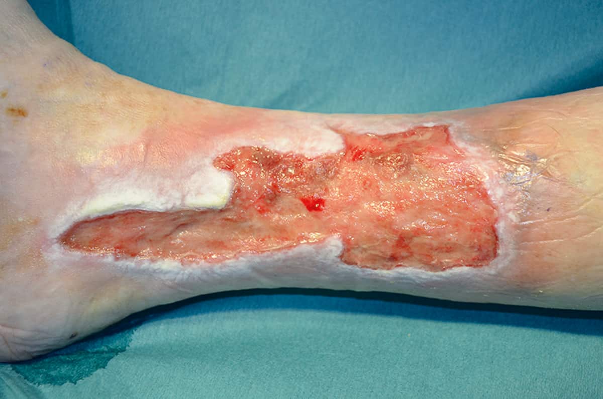 Understanding venous leg ulcers and how to manage them