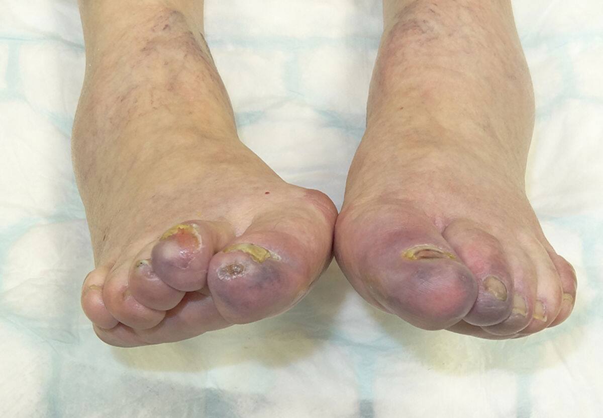 Diabetic foot ulcer