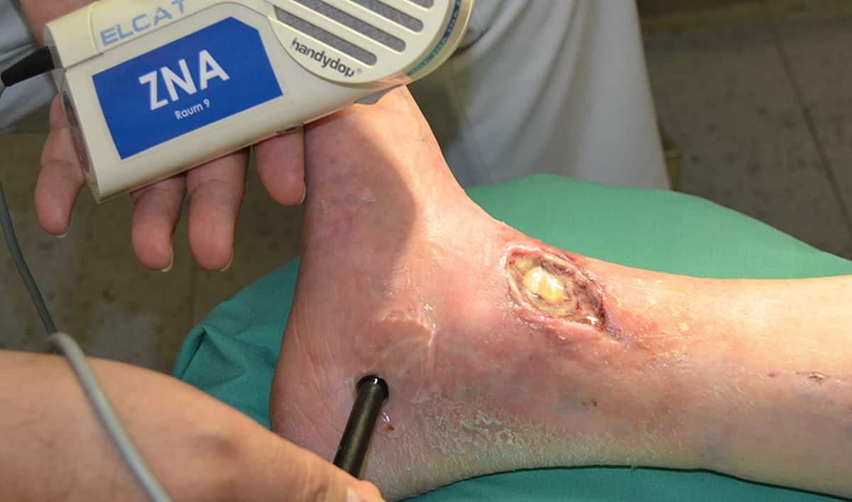 The principles of effective leg ulcer management