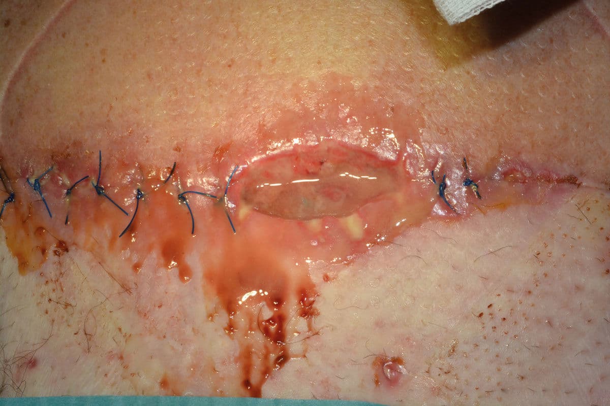Surgical wound dehiscence – what it is and why it is important