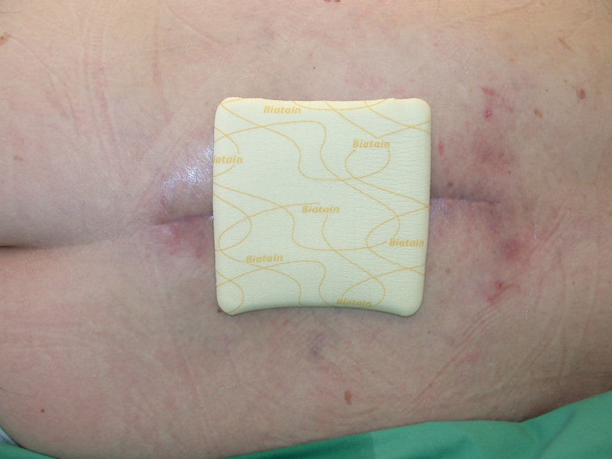 Choosing the right dressing