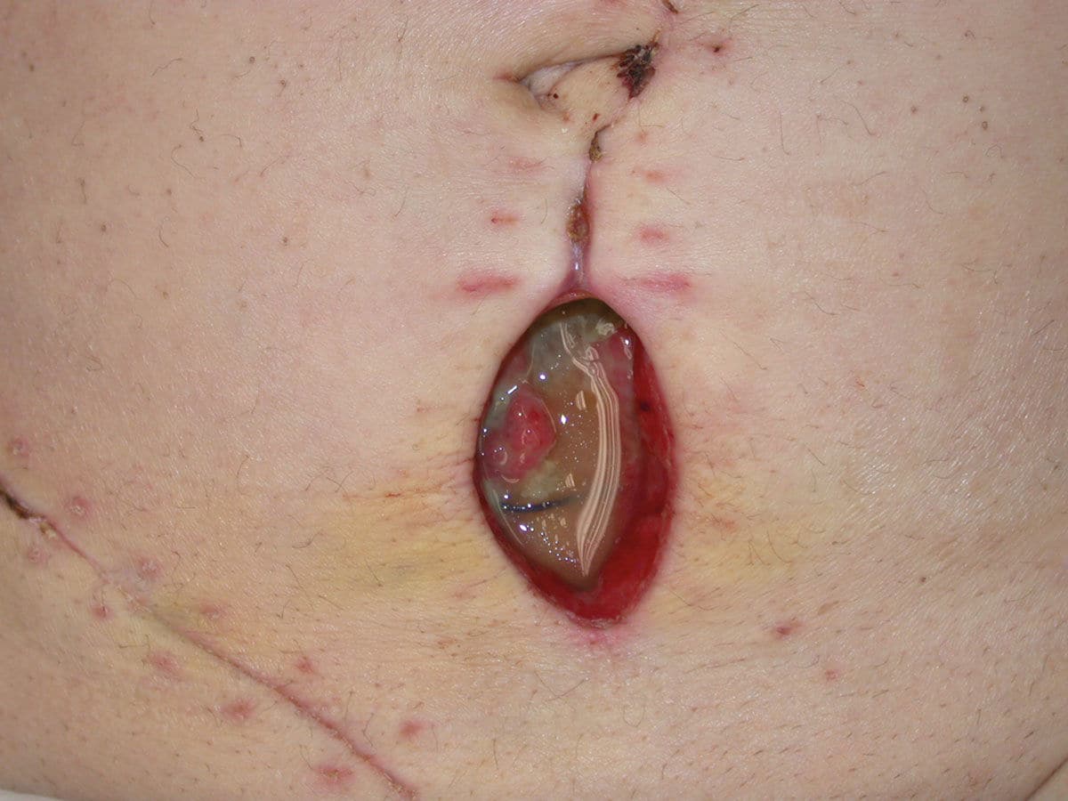 What is surgical wound dehiscence? 