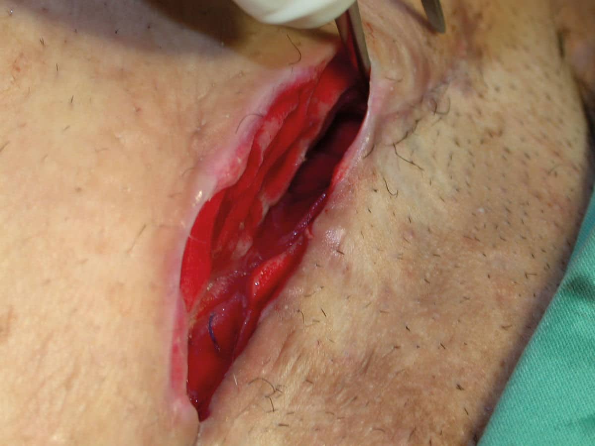 Understanding acute wounds