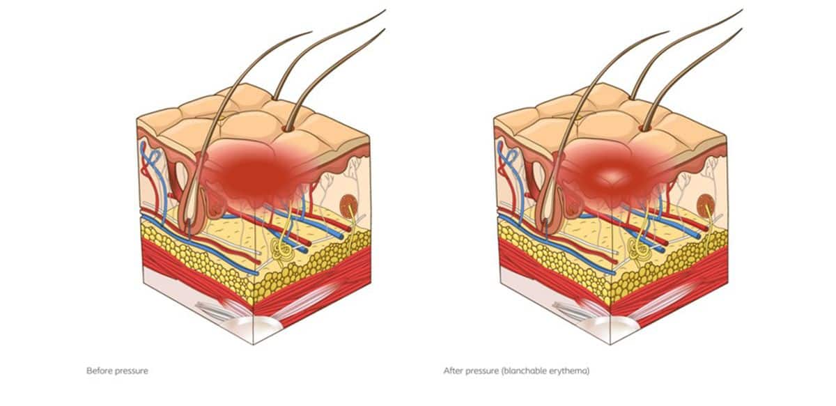 Blanchable erythema