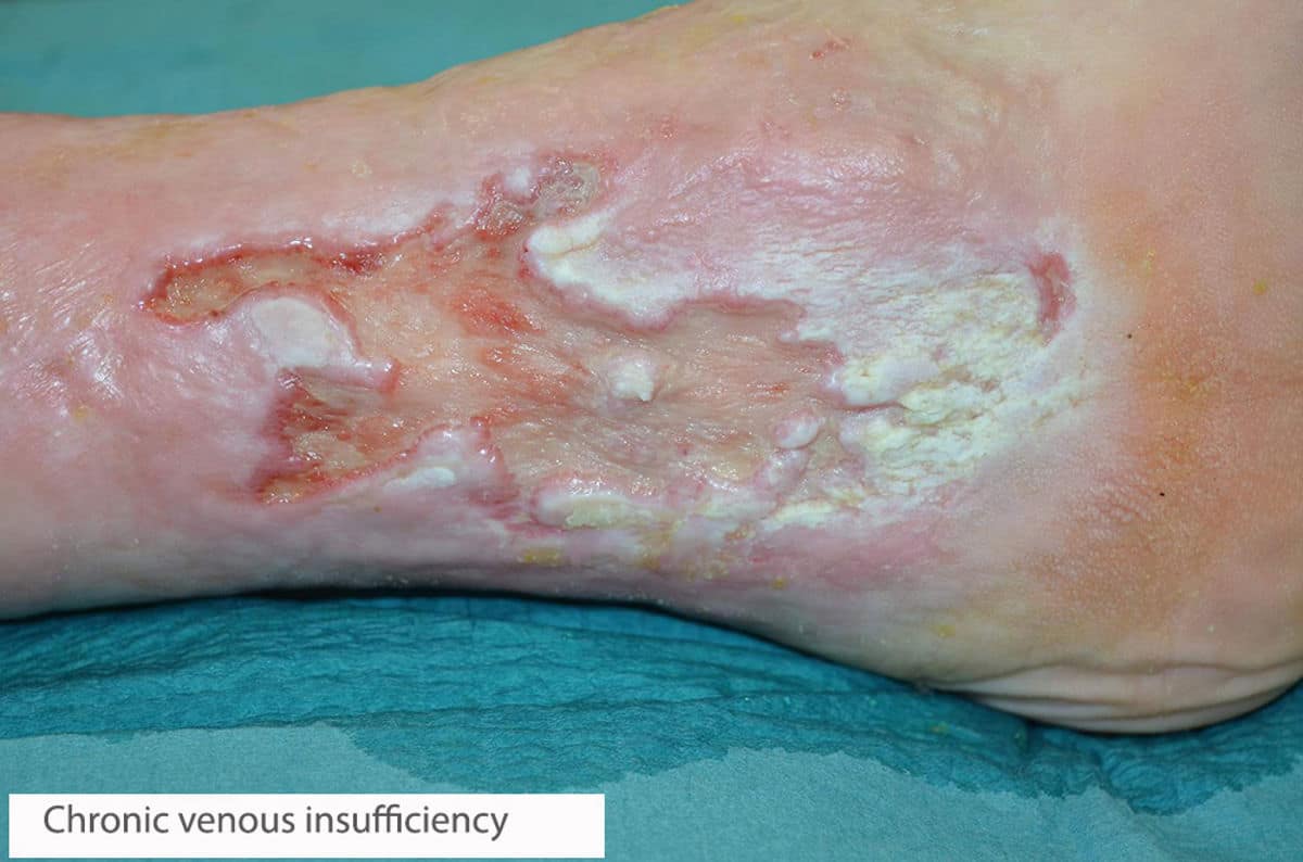 What is a chronic leg ulcer?