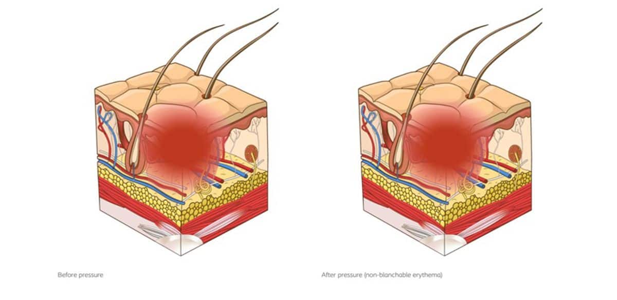 Non-blanchable erythema