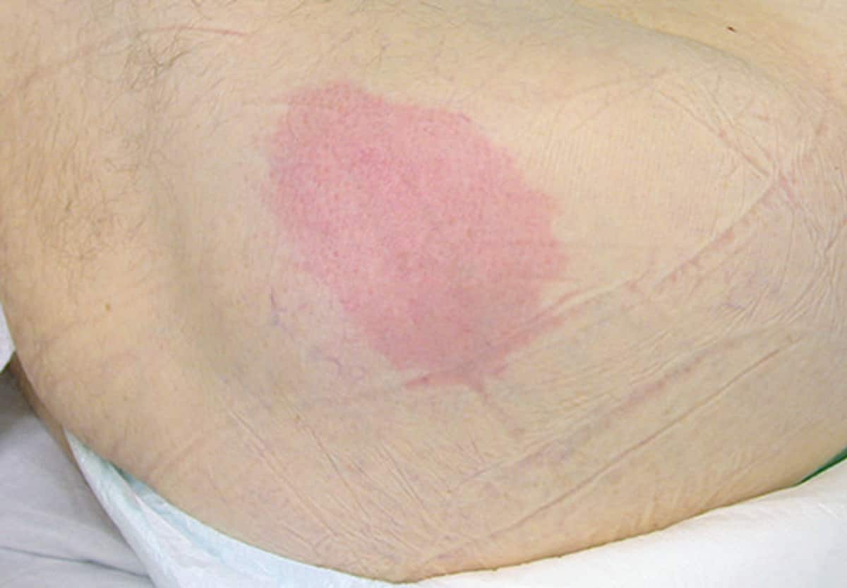 How to classify pressure injuries