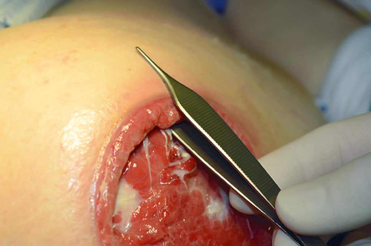 How to assess pressure injuries