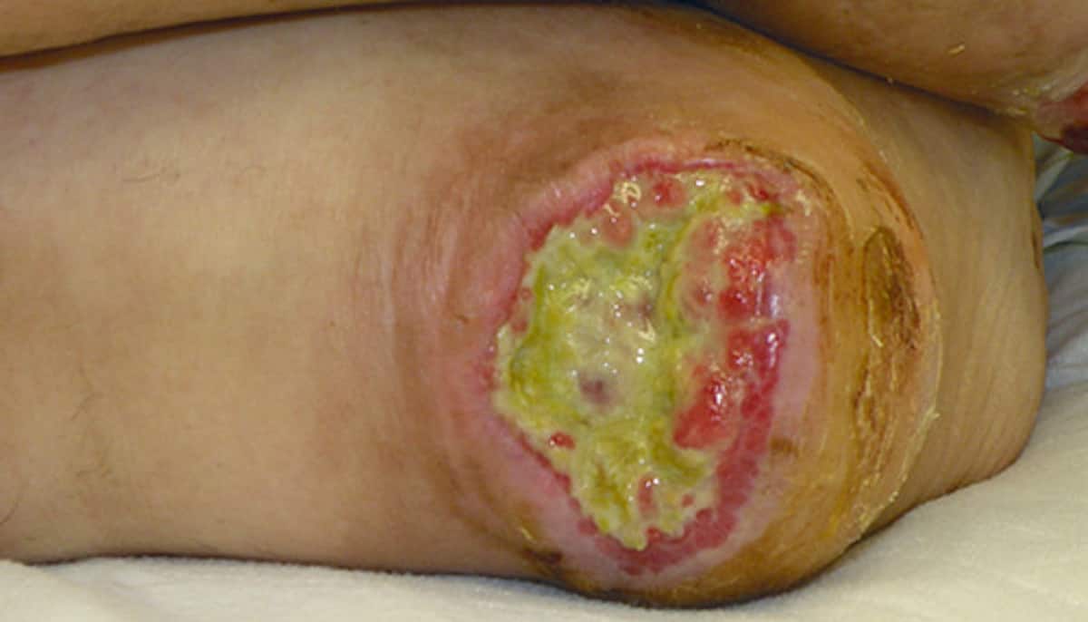 Pressure injuries: what are they and how do you prevent them?