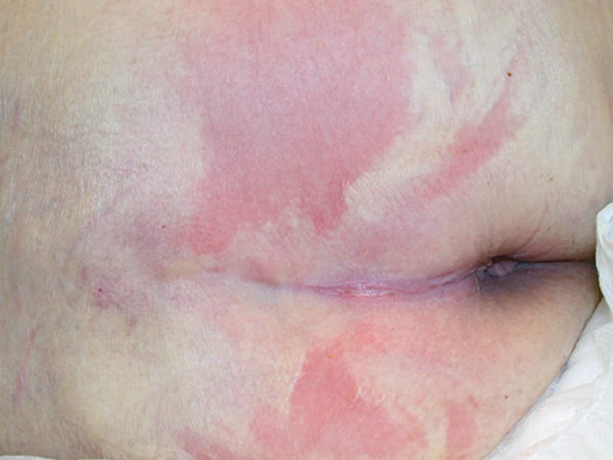 How to prevent pressure injuries