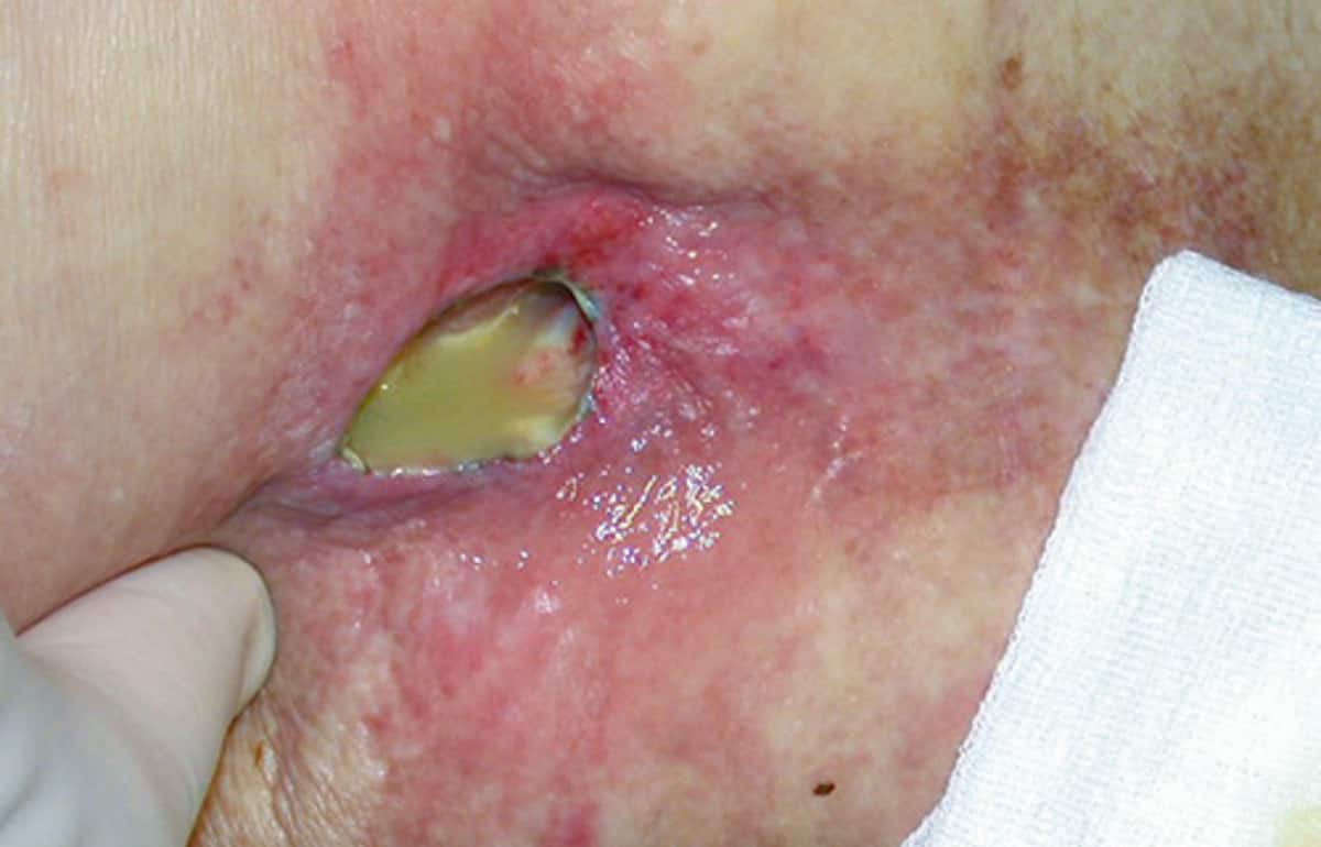 Pressure injuries and risk prevention