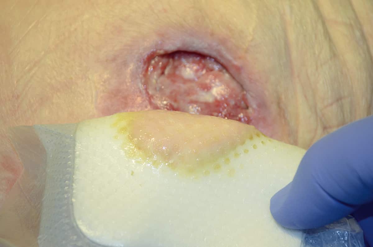 How to use protective dressings