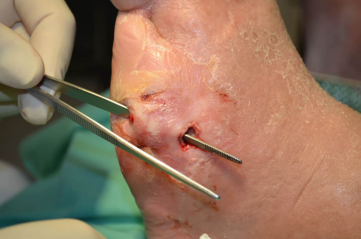 The two conditions that lead to diabetic foot disease