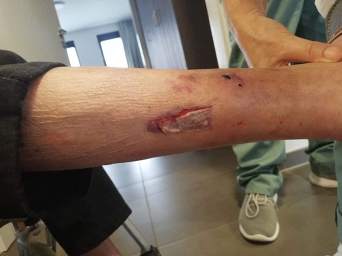 Understanding skin tears