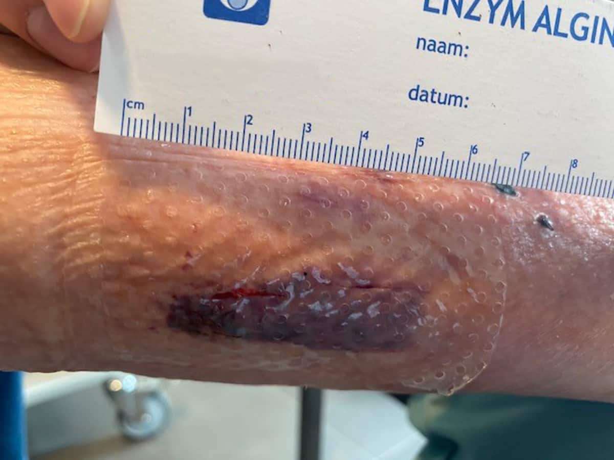 How to treat skin tears