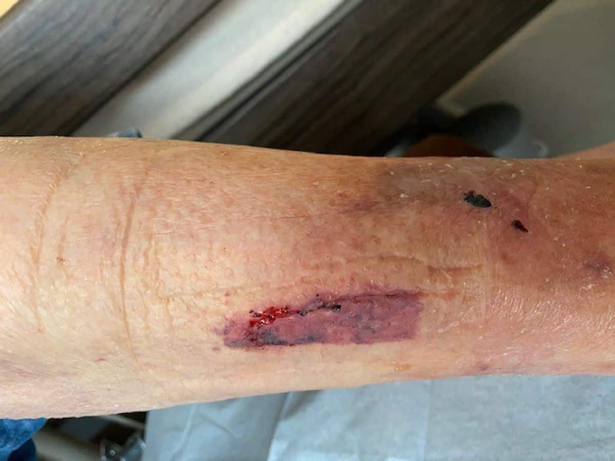 How to treat skin tears