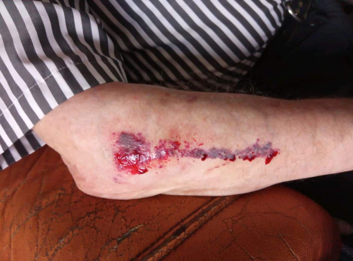 What is a skin tear?