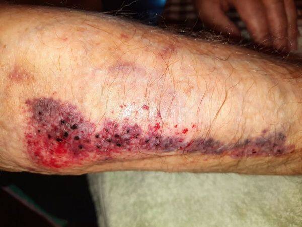 Skin Ripping Apart Understanding skin tears