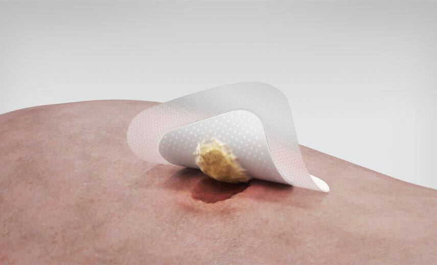 Biatain Silicone observational study Nurses saw progress towards healing